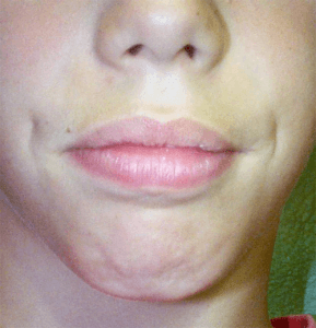 Exemple de déglutition atypique, l’enfant doit contracter ses lèvres et les muscles du menton pour déglutir 