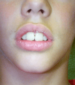 Exemple de lèvres ne pouvant pas se joindre au repos sans contraction musculaire